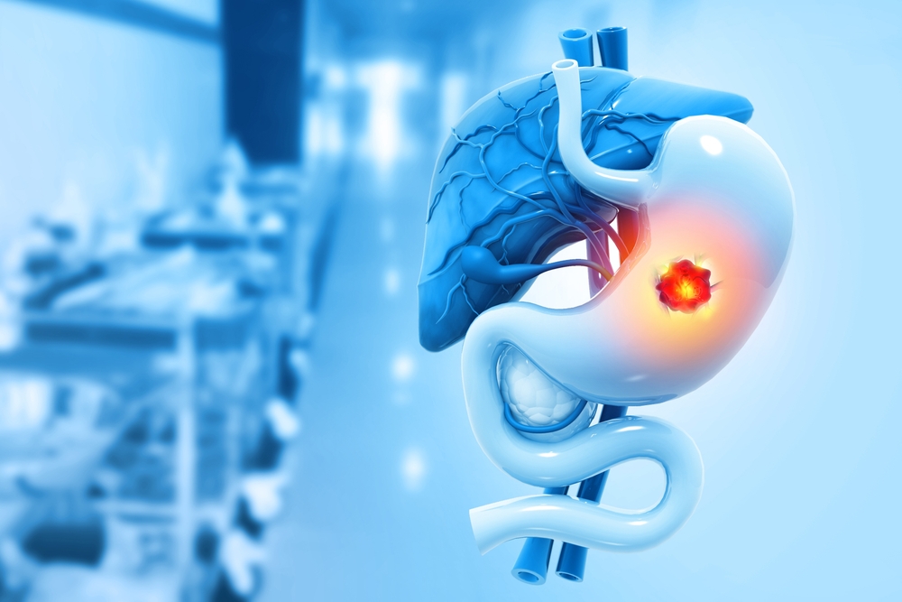 ilustratie cancer gastric